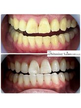 ホワイトニングサロン 京都烏丸店/ホワイトニング施術例