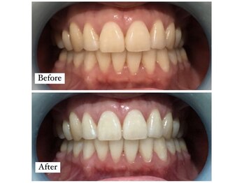 リジュベ(Rejuve)/セルフホワイトニング/船橋