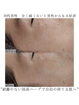 ヴェルシック(Belchic)/剥離のない国産ハーブピーリング