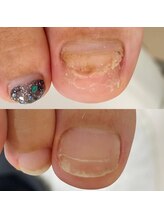 シーネイル(C Nail)/トラブル爪、まずは相談