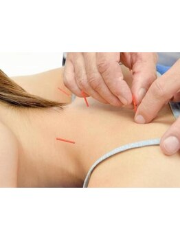 鍼灸施術を受けたい