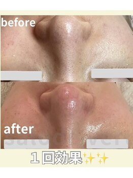 サロン ド ヴェール 一宮店(Salon de Vert)/毛穴ケア