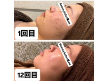 ビアラ(美ala)の雰囲気（毛穴やニキビケア等様々なお肌悩みにむけないハーブピーリング◎）