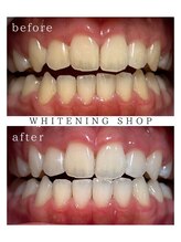 ホワイトニングショップ 長野店/10回終了時