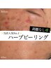 【迷ったらこれ！】ピーリング＋毛穴洗浄＋高保湿パック◆ニキビケア/毛穴