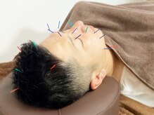 希実鍼灸院(nozomi)/美容鍼　【初めての方】