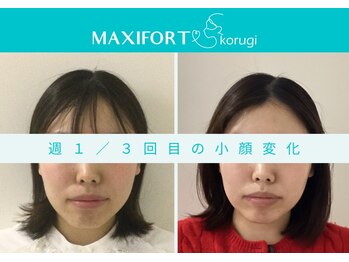 マキシフォート 名駅店(Maxifort)/週1 / 3回目での小顔変化