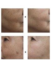 リリーローズ(LilyRose)/3-6ヶ月お肌