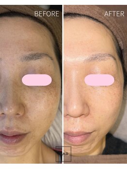 ギルドハナレ(GUILD HANARE)/"プラズマシャワー × シミケア"