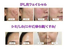 リゾートサロンドマーレ(Resort Salon de MARE)/IPL光フェイシャル