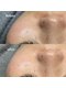 ユネ(une)の写真/【韓国式肌管理】 毛穴洗浄×ダクトピールで毛穴の黒ずみ・詰まり・開きを改善◎本気でお悩みの方へ！