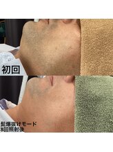 トリップ(trip)/髭脱毛