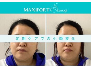 マキシフォート 名駅店(Maxifort)/定期ケアでの小顔変化