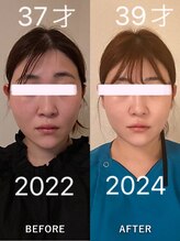 ミニョン(mignon)/