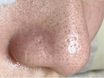 ルネッタ(Lunetta)の写真/SNSで話題の【毛穴エクストラクション】で本格毛穴ケア!頑固な黒ずみや角栓詰まり毛穴悩みお任せください♪