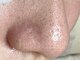 ルネッタ(Lunetta)の写真/SNSで話題の【毛穴エクストラクション】で本格毛穴ケア!頑固な黒ずみや角栓詰まり毛穴悩みお任せください♪