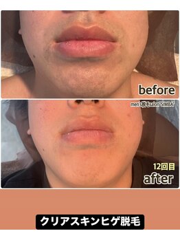 シンバ 倉敷店(SIMBA)/【ド定番】クリアスキンヒゲ脱毛