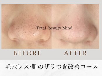 トータルビューティー マインド(Total Beauty)/毛穴レス肌のザラつき改善コース