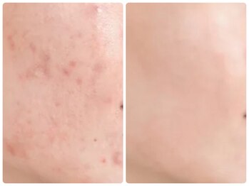 ルクシア(RUXCIA)/ビフォーアフター/ピーリング8回