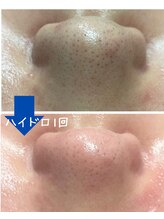 ラブニール 横浜店/ハイドロフェイシャル