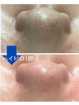 ラブニール 横浜店/ハイドロフェイシャル