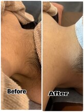 エイチビー(HB)/☆一度の脱毛でうなじスッキリ☆