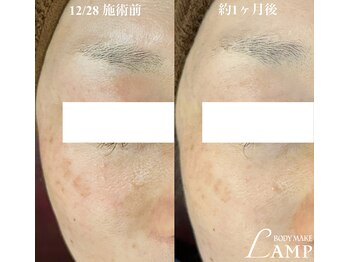 ランプ(LAMP)/シミ.シワ.ニキビ.毛穴ケアに☆