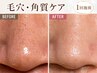 9月末まで【黒ずみ・ザラつき撃退!】毛穴洗浄ケア スキンケアセット付