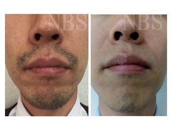 ブロンズ(BRONZE)/メンズ脱毛≪3回目≫