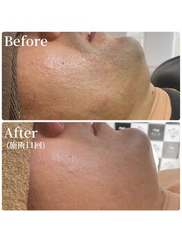 エース(ACE.)/髭脱毛ビフォーアフター☆