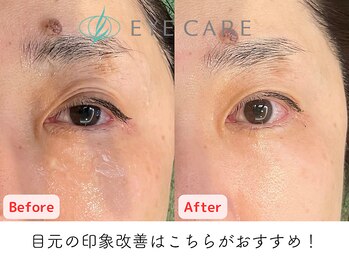 アイケアー(EYE CARE)/目元専門だからこの変化