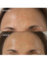 エピリス(Epiliss)/プラズマ眉間ビフォーアフター