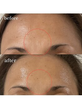 エピリス(Epiliss)/プラズマ眉間ビフォーアフター