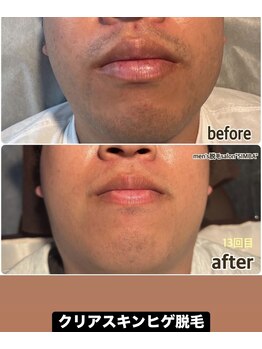 シンバ 倉敷店(SIMBA)/【ド定番】クリアスキンヒゲ脱毛