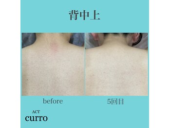アクト クロ(ACT curro)/【背中上】脱毛施術例