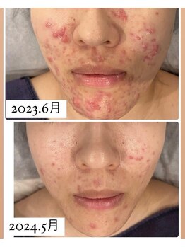 ヘルバ(HERBA)/フェイシャル