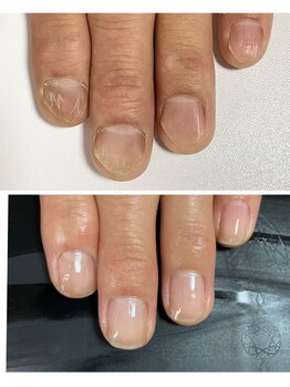 ルカロンネイル(Rukaron Nail)/トラブル爪