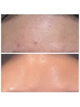 シェリル 松江店(CHARIRE)/ハーブピーリング/フェイシャル