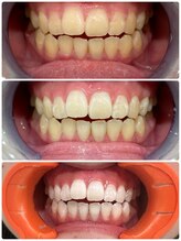 エクシアホワイトニング 日本橋店/イベント前お任せください