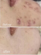 マリエンドリー/ニキビ改善