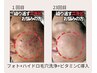 ニキビ肌質改善ビフォーアフター症例【フォト+ハイドラ+ビタミンC導入23回】