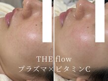 ザ フロウ(THE flow)/開き毛穴をプラズマでケア