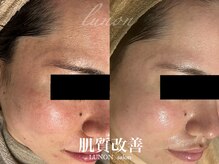 ルノン(Lunon)/肌質改善　《症例》