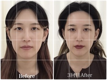 アキュモンド 渋谷院(acumond)/Perlコース初回と3回目の変化