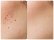 ルクシア(RUXCIA)/ビフォーアフターピーリング16回