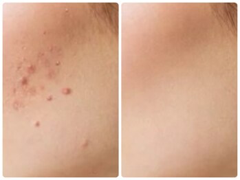 ルクシア(RUXCIA)/ビフォーアフターピーリング16回