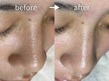 アルカンシエル(arcenciel)/毛穴改善コース