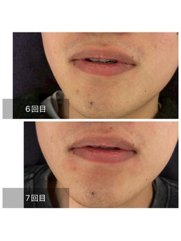 ダンニヒル(dannihil)/【髭脱毛】10代学生7回目