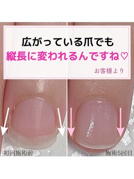 ミミ(mimi)/広がっている爪でも縦長に！