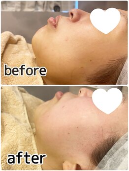 アデル 久留米(ADEL)/《全顔》フェイシャルワックス